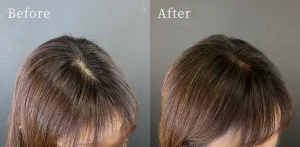 Allogeneic Program / iPSF Scalp Program (Scalp Injection) 3-session set