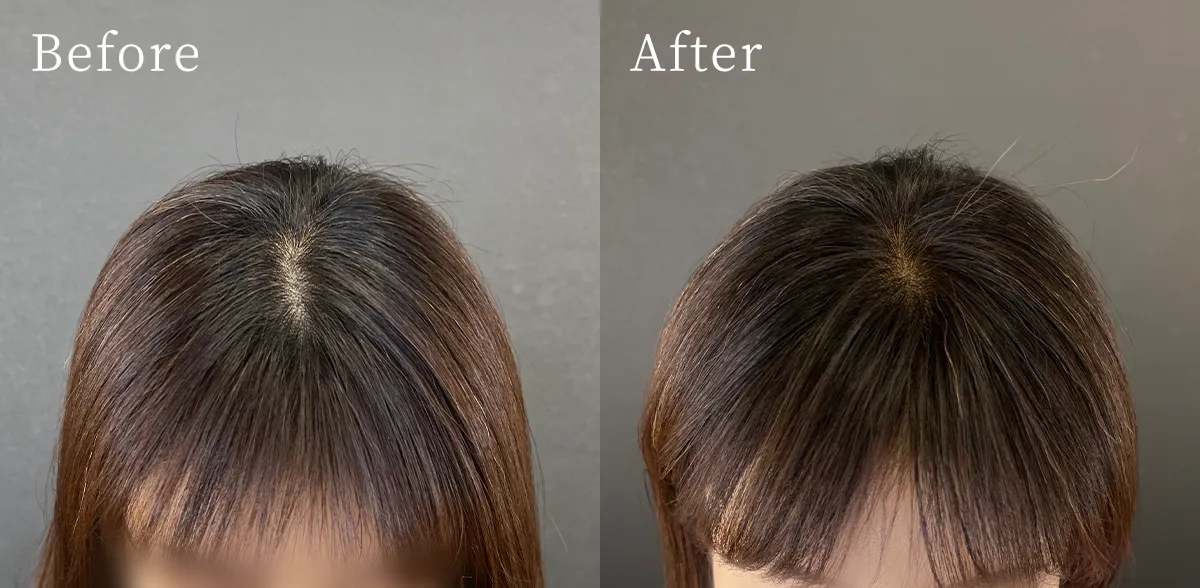 他家プログラム/iPSF頭皮投与プログラム（頭皮注入）　3回セット Before After 1